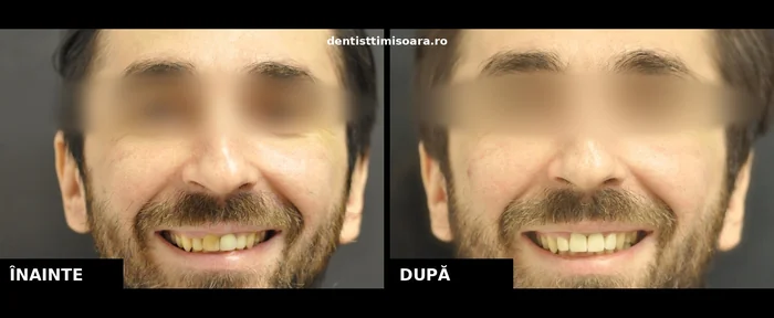 Coroane zirconiu-ceramică grup frontal Timișoara - înainte și după