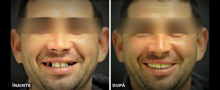 Extracții multiple și reabilitare protetică Timișoara - înainte și după